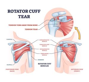 Diagrama de lesión de hombro — manguito rotador en accidentes de trabajo — workers comp lawyer Chicago